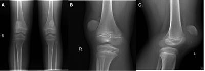 Bilateral sleeve fracture of the inferior pole of the patella in children: A case report